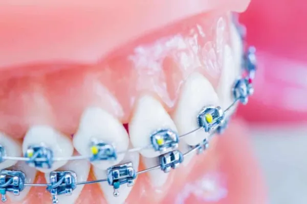 Traditional Braces