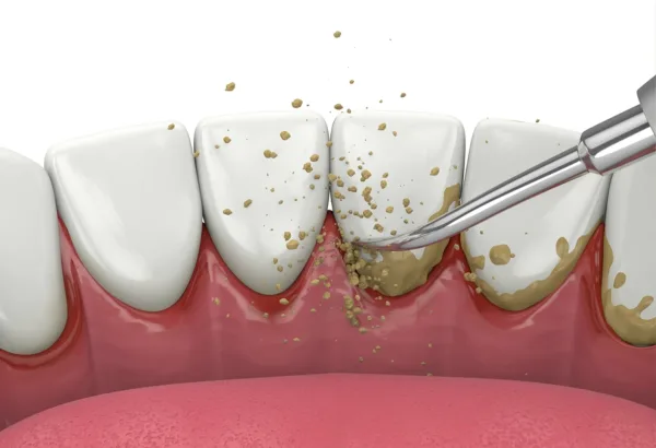 Teeth scaling & polishing