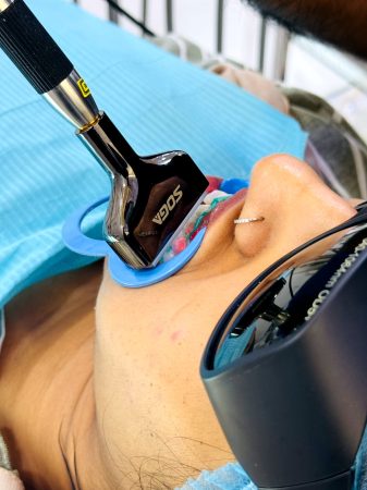 Laser light teeth whitening