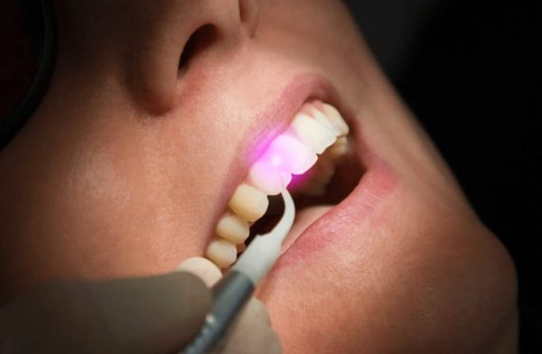 Laser assisted root canal treatment