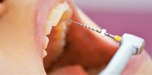 Endomotor Root canal treatment