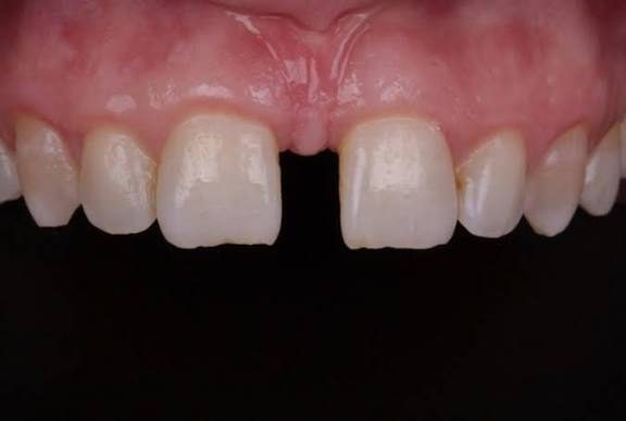 Midline Diastema Correction
